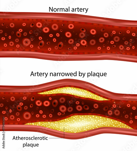 Photography Artery narrowed by plaque and Normal artery