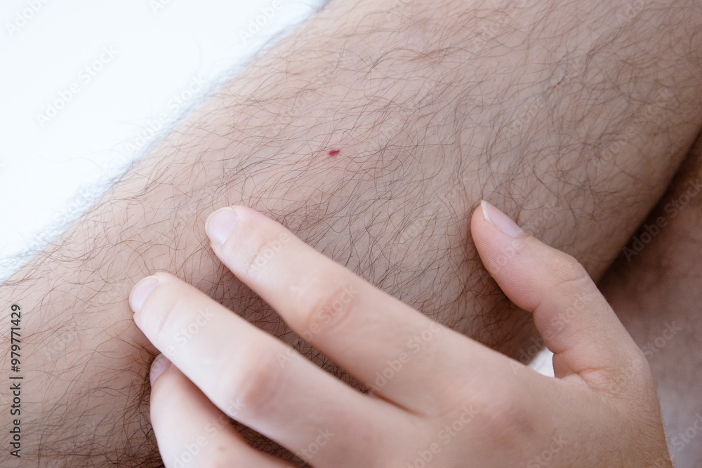 closeup of a bite mark on a man's leg. insects and humans. rules of conduct in the wild. treatment of poisonous bites. medical healthcare closeup of a bite mark on a man's leg. insects and humans. rules of conduct in the wild. treatment of poisonous bites. medical healthcare