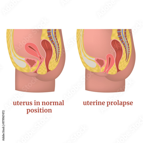 Medical diagram with uterine prolapse. Before and after. Vector graphics