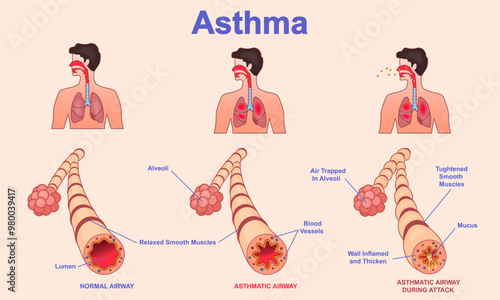 Anatomy of Asthma. Medical diagram showing stages of asthma attack with healthy and unhealthy bronchial tube. Breathing problems and respiratory muscle tightening. Cartoon flat vector illustration
