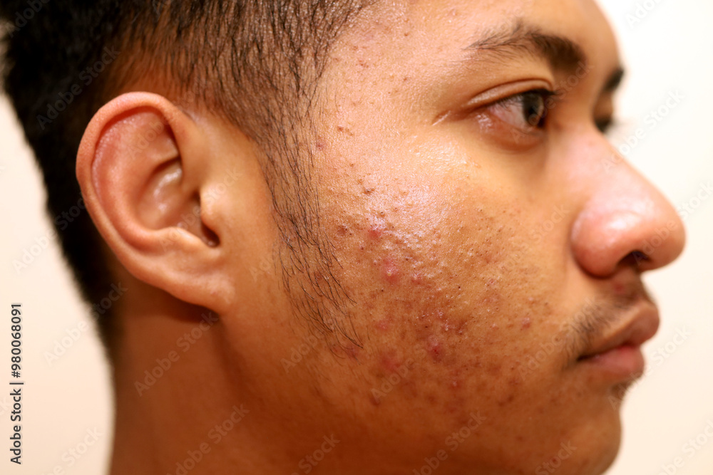 Obraz premium Indonesian boy's face with pimples on cheeks, inflamed pimples.