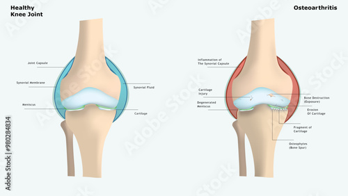 Osteoarthritis 