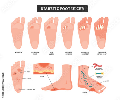 Set of Diabetic Food Ulcer 
medical infographic healthcare poster design for education, labeled stages of foot ulcer, diabetes gangrene necrosis neuropathy wound necrotizing fasciitis infarction frost