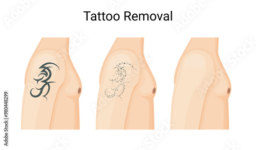 Laser Tattoo Removal Procedure for Clear Skin