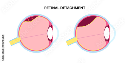 Retinal detachment eye disease