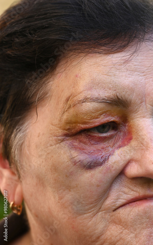 Senior woman with big bruise on eye