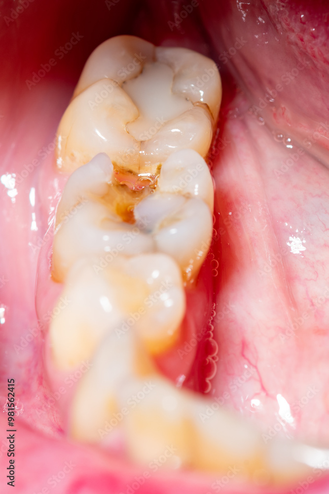 Cracked second molar tooth in need of a crown with a shallow depth of field Cracked second molar tooth in need of a crown with a shallow depth of field