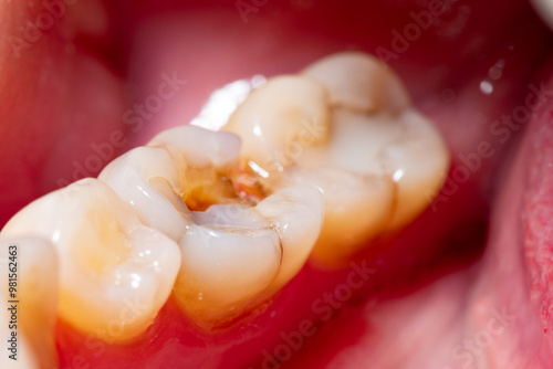 Cracked second molar tooth in need of a crown with a shallow depth of field photo