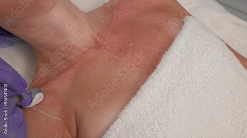 Treatment of decollete area skin by injection method, performed with sterile gloves and syringe, close up. Procedure of injection into female Upper Chest skin treatment with gloved hands