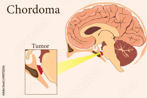 Chordoma is a rare malignant tumor originating from notochordal remnants, primarily affecting the spine. eps 10