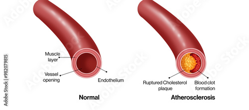 Detailed Vector Illustration of Normal and Atherosclerotic Blood Vessels: A Comparative Study of Vascular Anatomy and Pathology with Labels