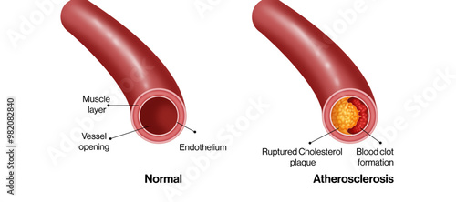 Detailed Vector Illustration of Normal and Atherosclerotic Blood Vessels: A Comparative Study of Vascular Anatomy and Pathology with Labels