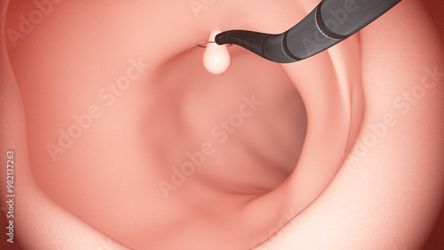 Medical Procedure for Polyp Removal in Colon