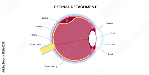 Retinal detachment eye disease