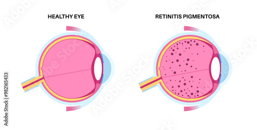 Retinitis pigmentosa poster