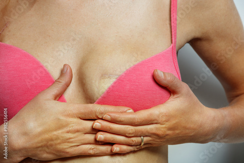 Quadro su tela Post-surgery scar on a young woman chest in pink bra close-up