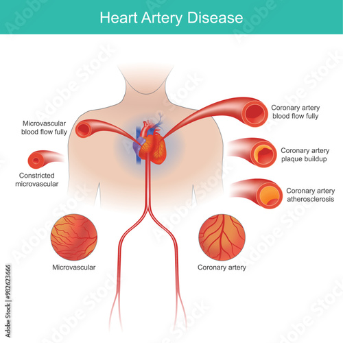 Heart Artery Disease. Reduced blood flow to the heart can cause chest pain and shortness of breath.