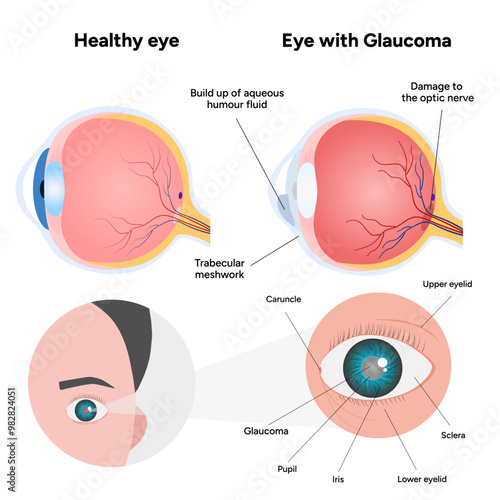 Eye with glaucoma disease and healthy eye medical infographic with human optic eye anatomy
