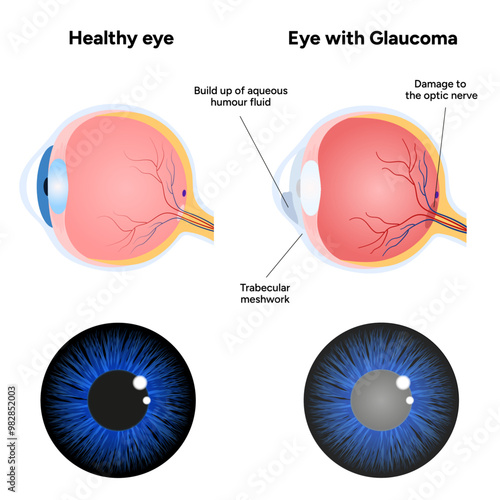 Eye with glaucoma disease and healthy eye medical infographic with human optic eye anatomy