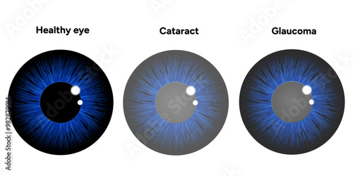 Healthy eye, cataracts and eye glaucoma disease 