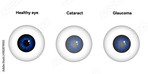 Healthy eye, cataracts and eye glaucoma disease 