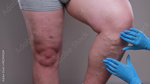 Removal of varicose veins on the legs. Medical inspection and treatment of Telangiectasia. Phlebeurysm.sclerotherapy