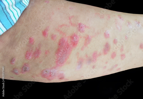 A raised, red, target like rash on the skin or mucous membranes characteristic of erythema multiforme photo