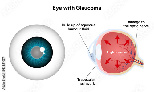 Eye with glaucoma disease, medical infographic with human eye optic anatomy