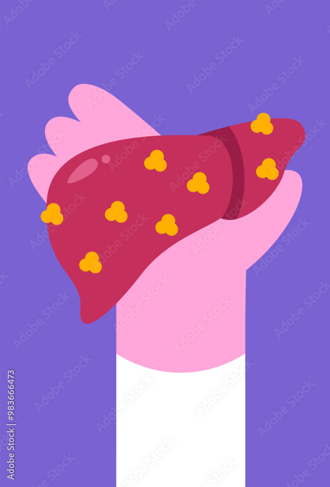 Liver full of fat in human hand. Fatty disease of the liver organ or Hepatosteatosis. Increased fat deposition in the liver. Warning about problematic organs. Flat vector illustration. Liver full of fat in human hand. Fatty disease of the liver organ or Hepatosteatosis. Increased fat deposition in the liver. Warning about problematic organs. Flat vector illustration.