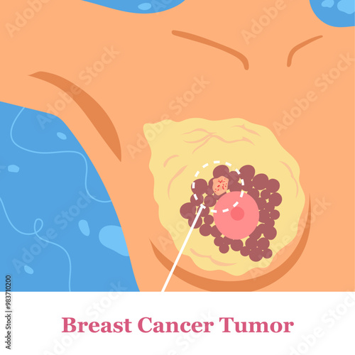 breast cancer tumor found in women body anatomy flat illustration