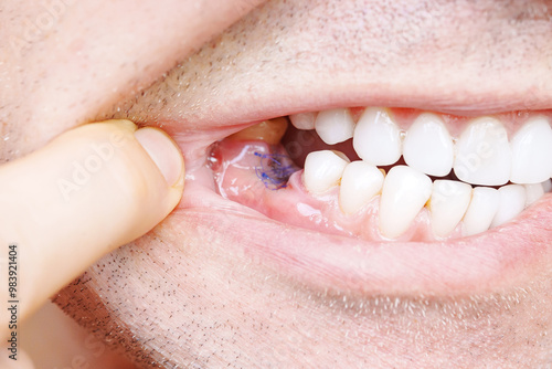 close-up. man showing a sutured socket in the oral cavity after tooth extraction. the work of a dentist surgeon.