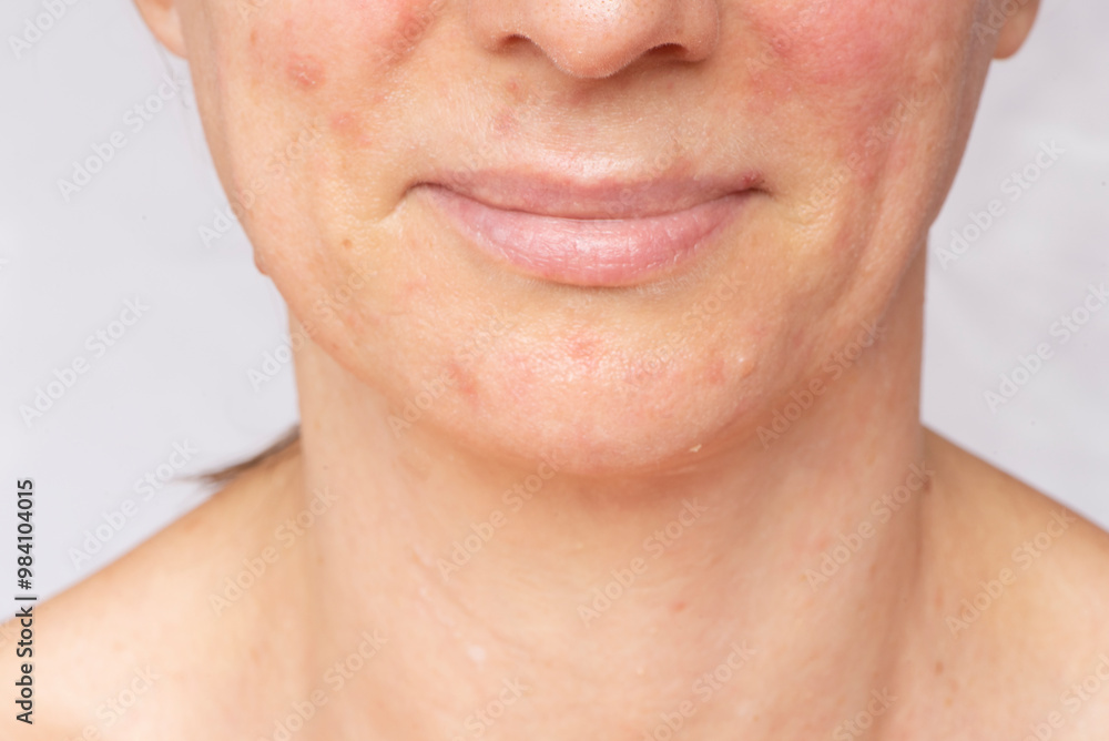 Obraz premium Allergic symptoms on the skin of the face of women. The problem, prevention and care for healthy clean skin.