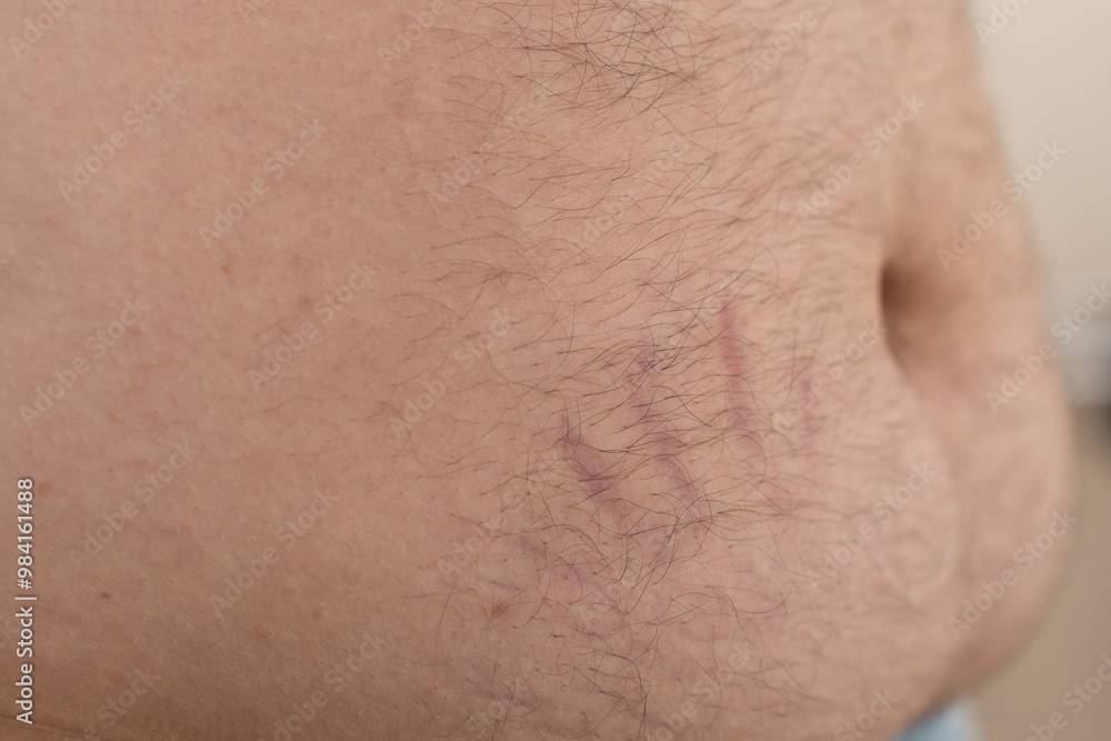 A close-up of a human belly with stretch marks and visible body hair. A close-up of a human belly with stretch marks and visible body hair.