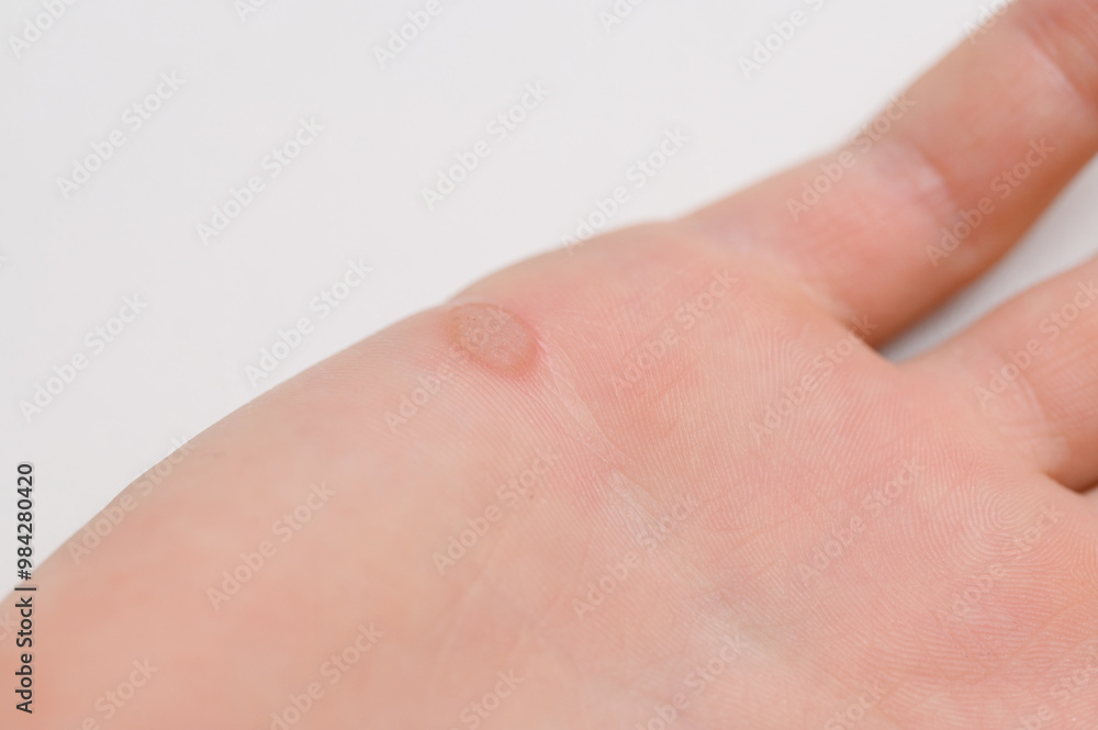 Viral flat warts Verruca vulgaris, on hand, close-up. Human papillomavirus, HPV. Concept of pediatric dermatology, treatment of warts Viral flat warts Verruca vulgaris, on hand, close-up. Human papillomavirus, HPV. Concept of pediatric dermatology, treatment of warts