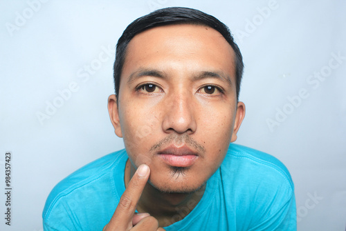 Close up of young Asian man face pointing to a white spot near the lips called Pityriasis alba.