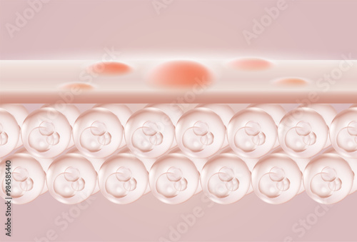 acne illustration