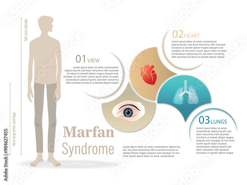 Educational illustration depicting Marfan Syndrome features, including height and impacts on heart and lungs