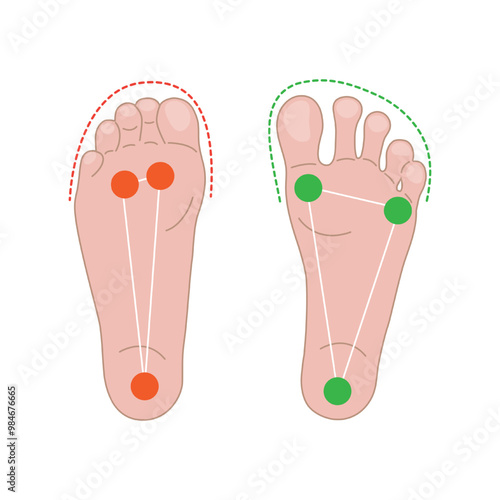 A foot in narrow shoes has unnatural support and shape, a foot in wide shoes has natural support, healthy feet.