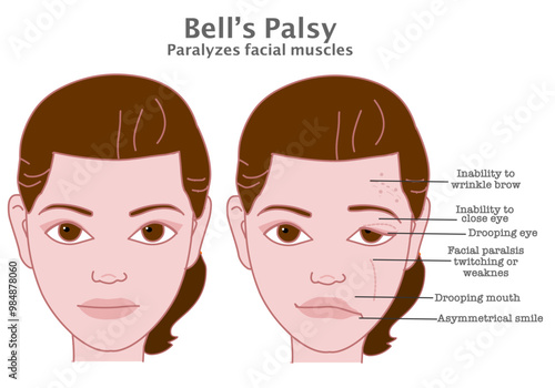 Bell palsy. Facial muscle paralysis. Drooping, close eyes. twitching weakness causes. asymmetric woman face, smile. Medical illustration vector	