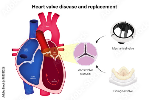 Heart valve disease. Aortic valve replacement with mechanical valve or Biological valve. Heart anatomy vector. 
