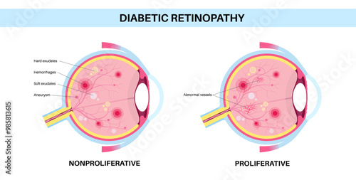 Diabetes related retinopathy