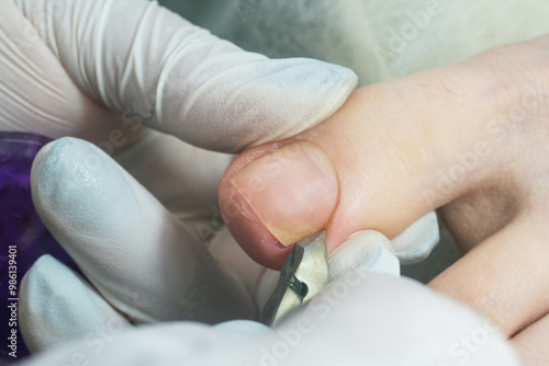 Podiatrist using pedicure clippers trims dry skin around a toenail