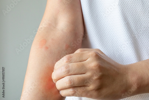 Young asian man itching and scratching on arm from allergic itchy dry skin eczema dermatitis insect bites photo