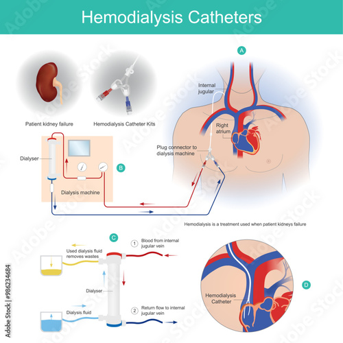 Hemodialysis Catheters. A dialysis catheter is a catheter used for exchanging blood from heart to and from a hemodialysis machine and a patients.