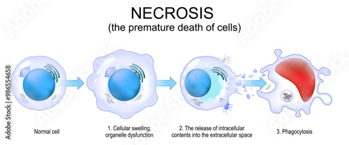 Necrosis. Uncontrolled cell death.