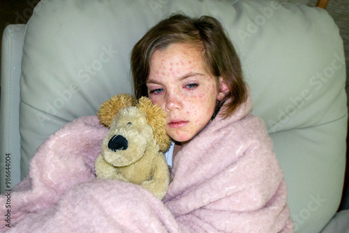 Natural vaccination. Contagious disease. Sick child with chickenpox. photo