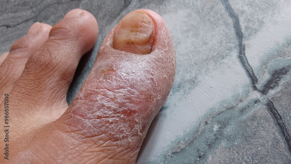 Fototapeta premium the skin of the big toe is cracked and watery. eczema disease
