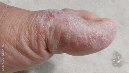 the skin of the big toe is cracked and watery. eczema disease