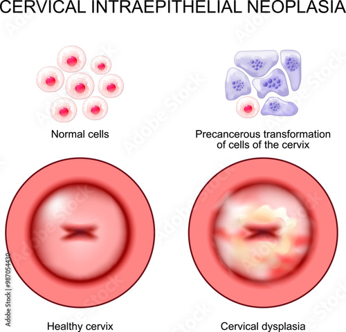 Cervical intraepithelial neoplasia. Cervical dysplasia. CIN