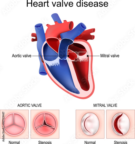 Heart valve disease. Healthy valve and Stenosis.